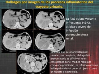 Hallazgos por imagen de los procesos inflamatorios del
trayecto urinario.
La PXG es una variante
infrecuente (<1%),
atípica y severa de
infección
parenquimatosa
renal.
Debido a que sus manifestaciones
simulan una neoplasia, el diagnóstico
preoperatorio es difícil y si no es
considerado por el médico radiólogo
como una posibilidad, es referido como un
hallazgo incidental por el cirujano o como
un reporte de patología.
 