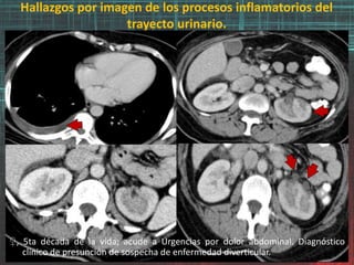 Hallazgos por imagen de los procesos inflamatorios del
trayecto urinario.
♀, 5ta década de la vida; acude a Urgencias por dolor abdominal. Diagnóstico
clínico de presunción de sospecha de enfermedad diverticular.
 