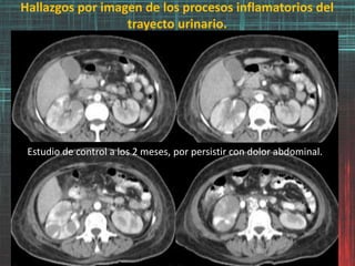 Hallazgos por imagen de los procesos inflamatorios del
trayecto urinario.
Estudio de control a los 2 meses, por persistir con dolor abdominal.
 