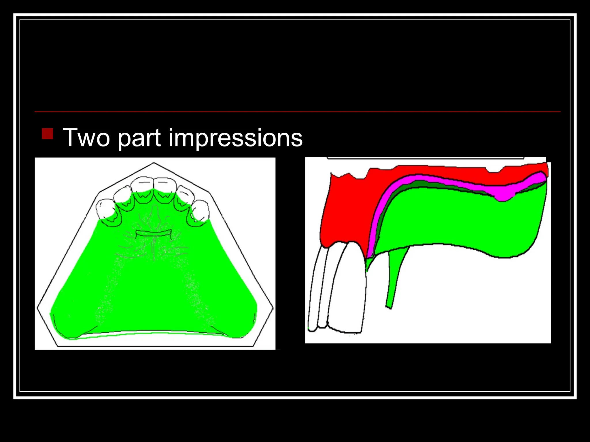  Two part impressions
 