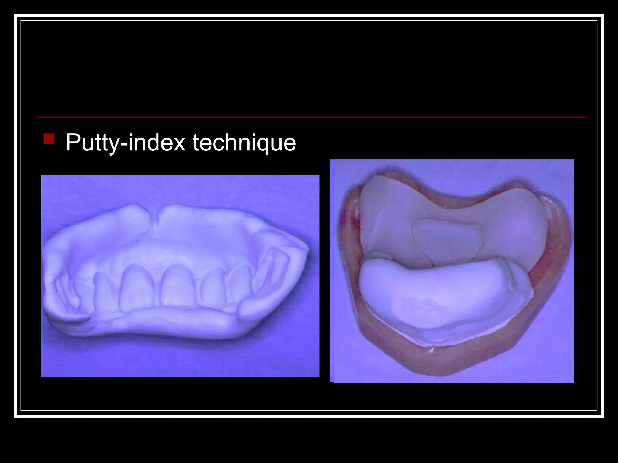  Putty-index technique
 