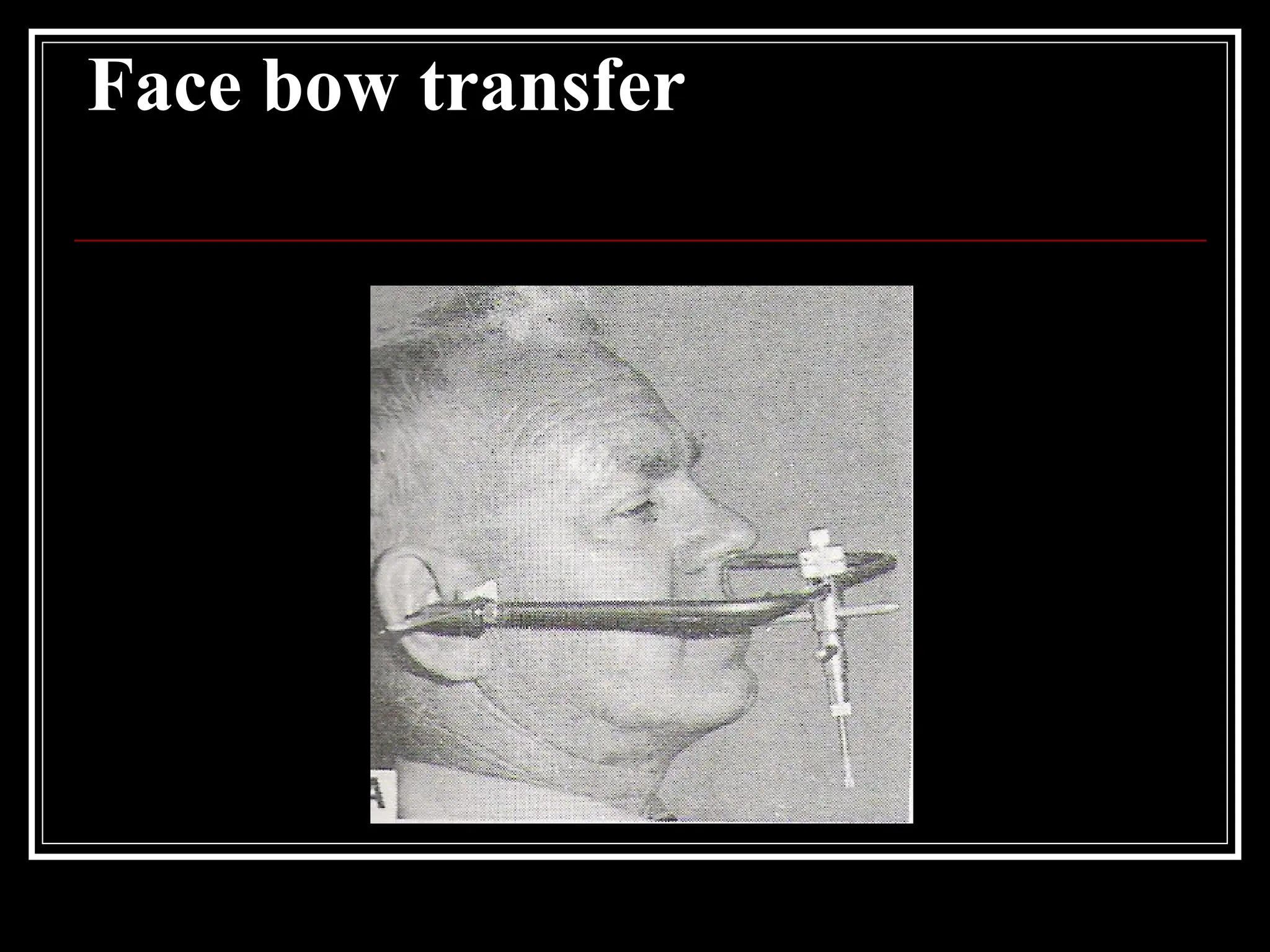Face bow transfer
 