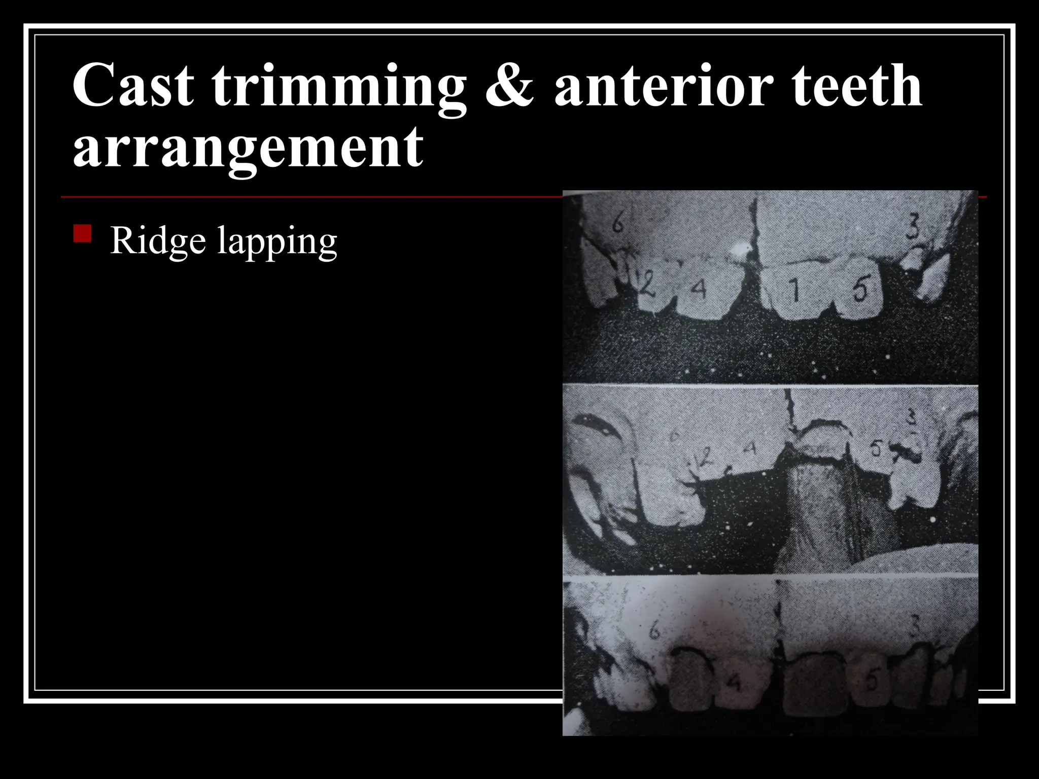 Cast trimming & anterior teeth
arrangement
 Ridge lapping
 