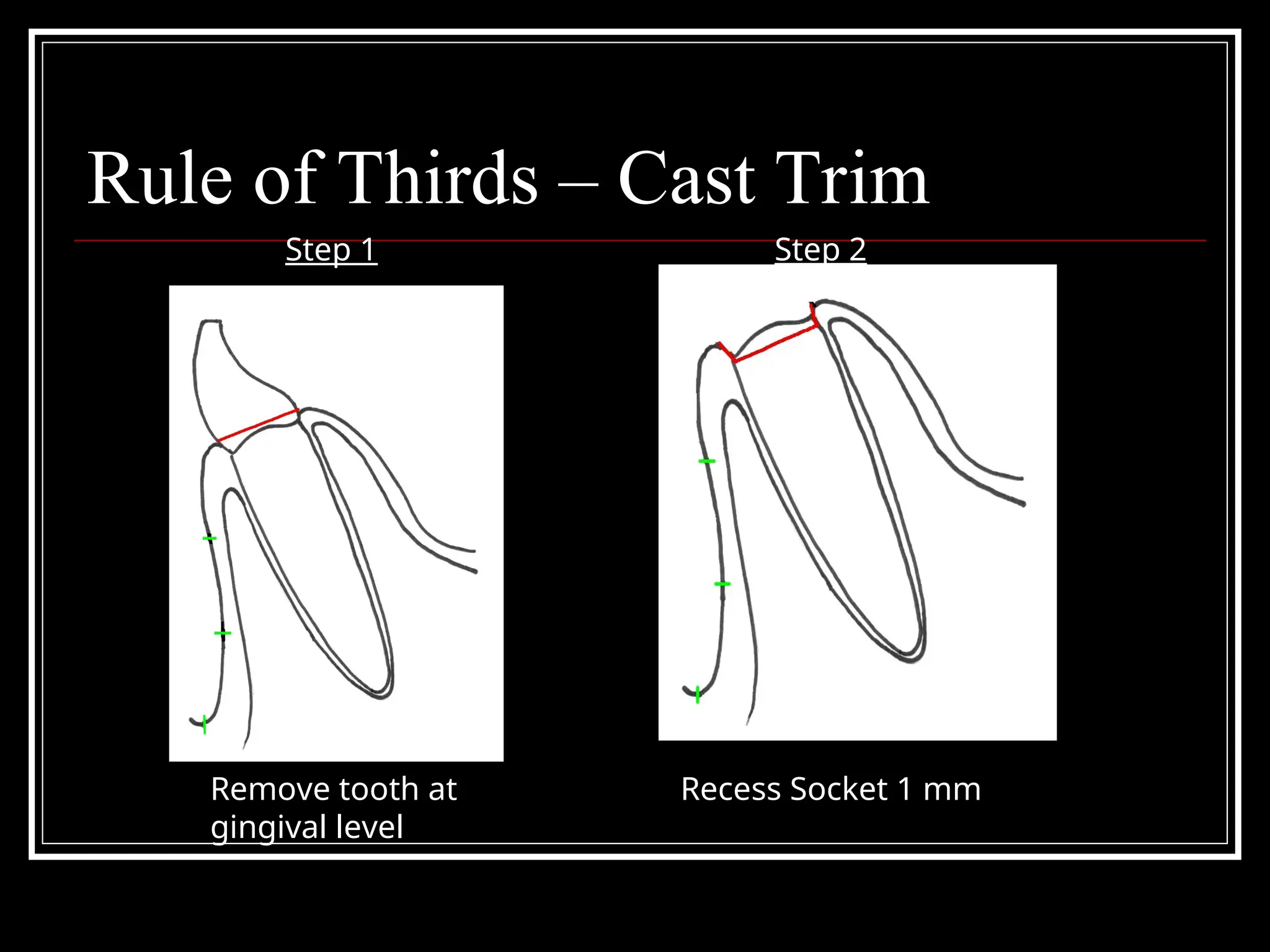 Rule of Thirds – Cast Trim
Recess Socket 1 mm
Remove tooth at
gingival level
Step 1 Step 2
 