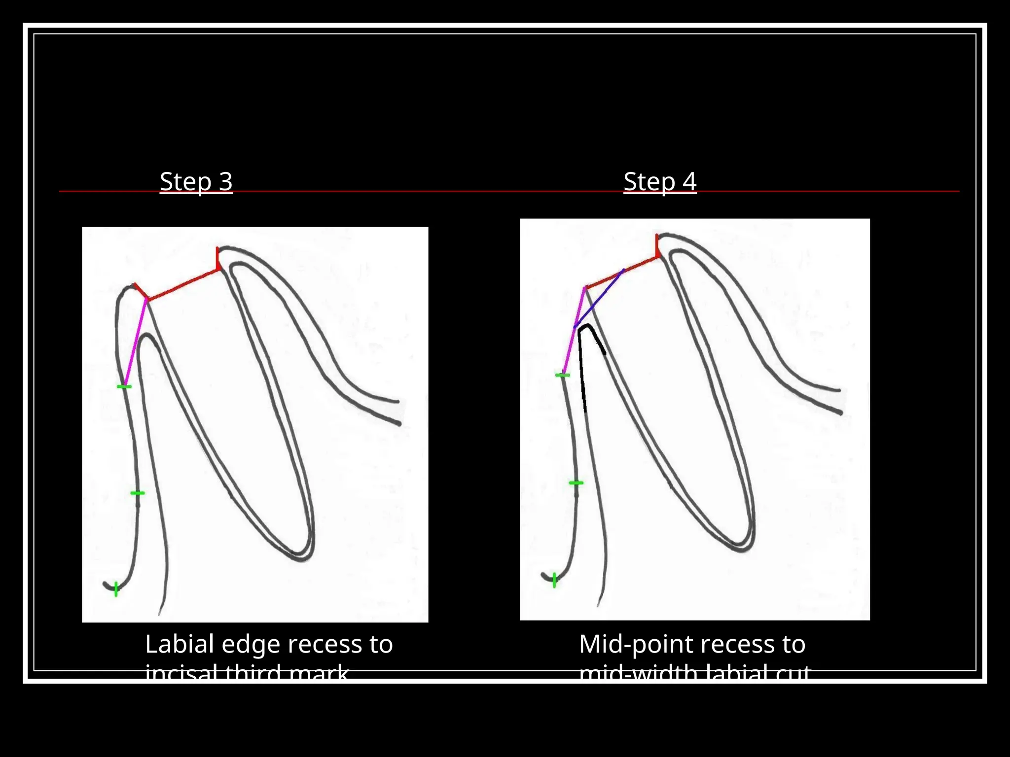 Step 3 Step 4
Labial edge recess to
incisal third mark
Mid-point recess to
mid-width labial cut
 
