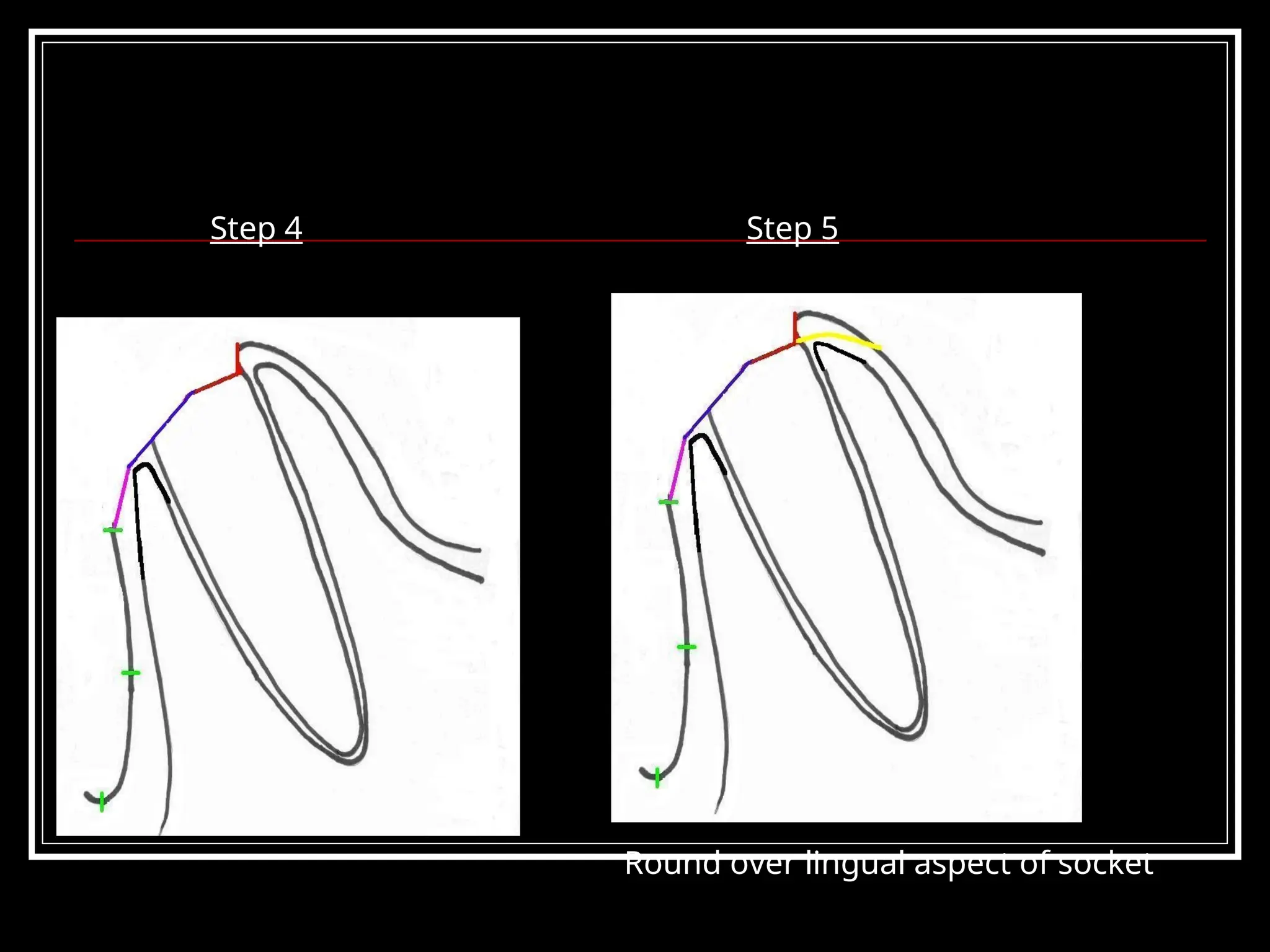 Step 4 Step 5
Round over lingual aspect of socket
 