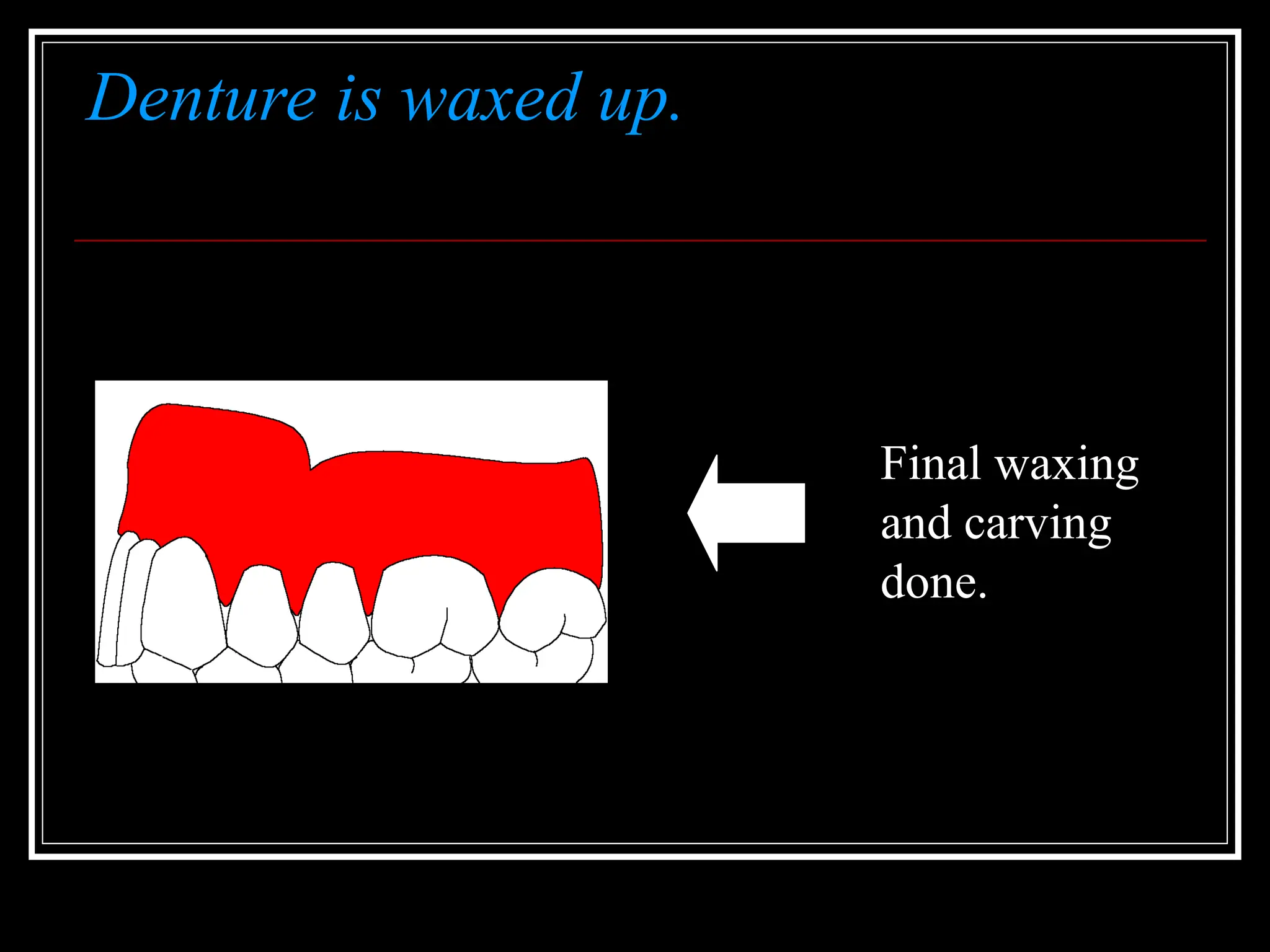 Denture is waxed up.
Final waxing
and carving
done.
 