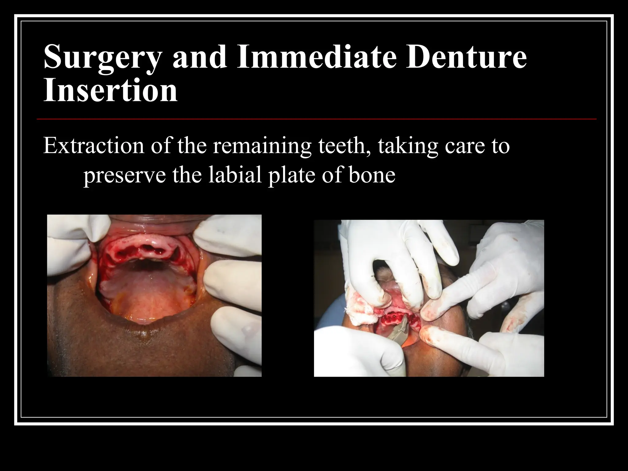 Surgery and Immediate Denture
Insertion
Extraction of the remaining teeth, taking care to
preserve the labial plate of bone
 