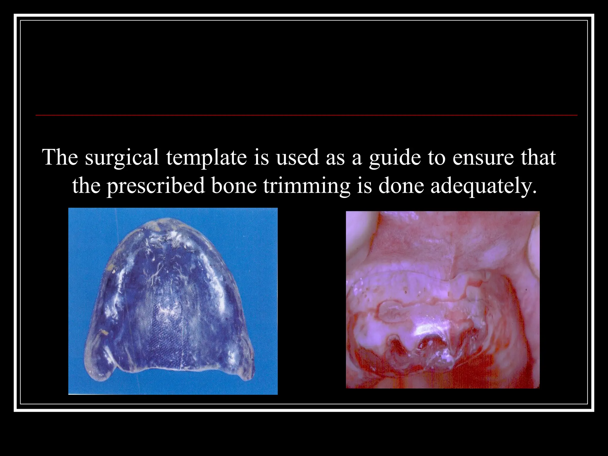 The surgical template is used as a guide to ensure that
the prescribed bone trimming is done adequately.
 