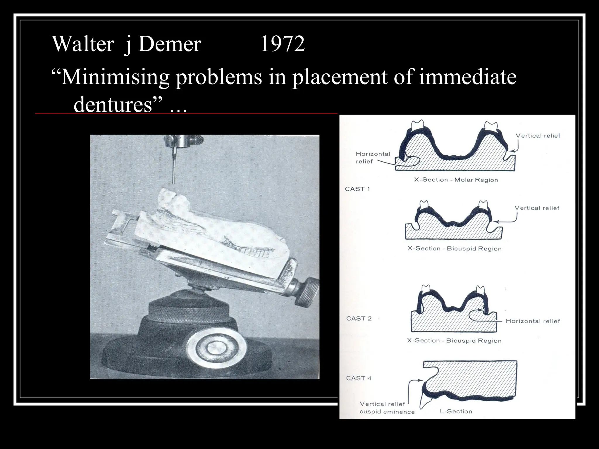 Walter j Demer 1972
“Minimising problems in placement of immediate
dentures” …
 