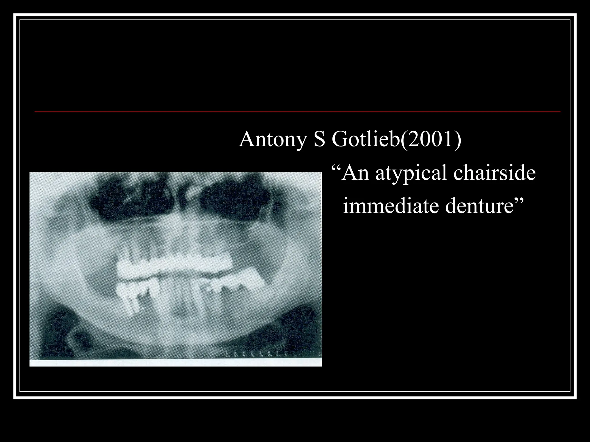 Antony S Gotlieb(2001)
“An atypical chairside
immediate denture”
 
