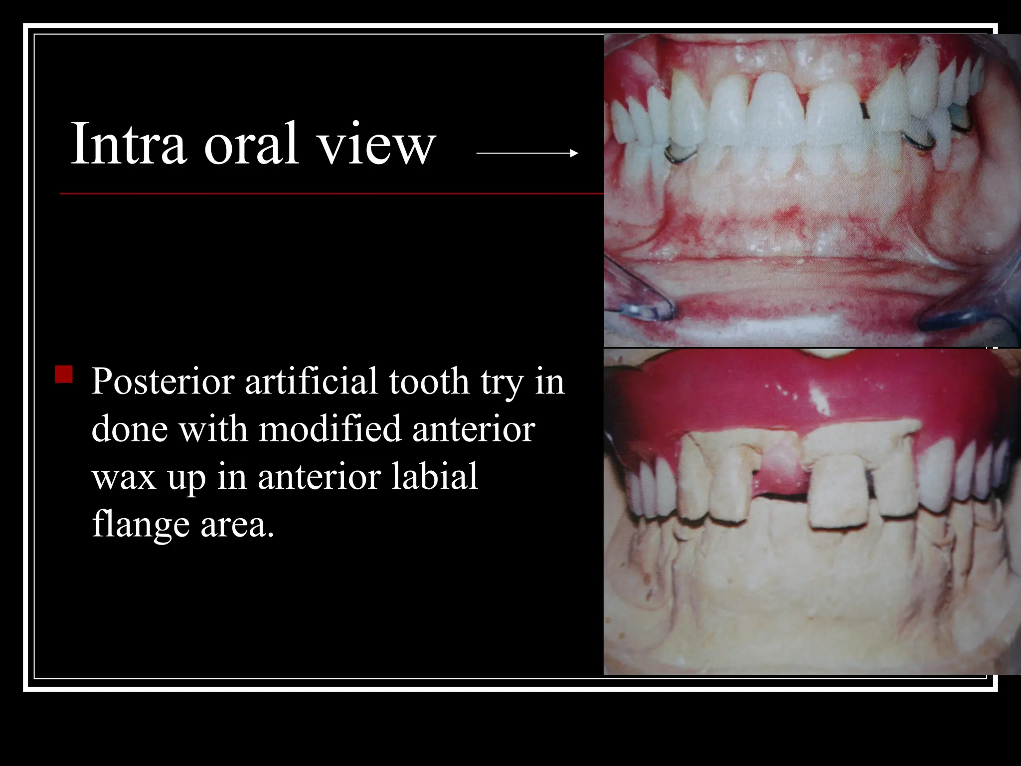 Intra oral view
 Posterior artificial tooth try in
done with modified anterior
wax up in anterior labial
flange area.
 