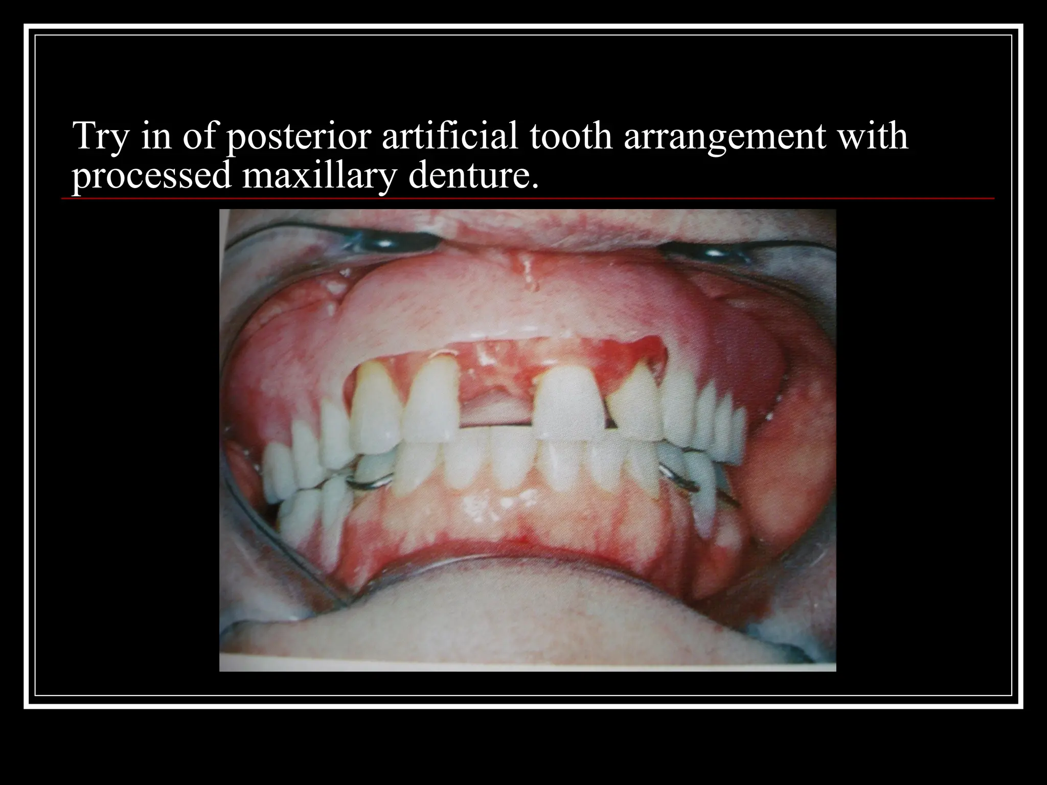 Try in of posterior artificial tooth arrangement with
processed maxillary denture.
 