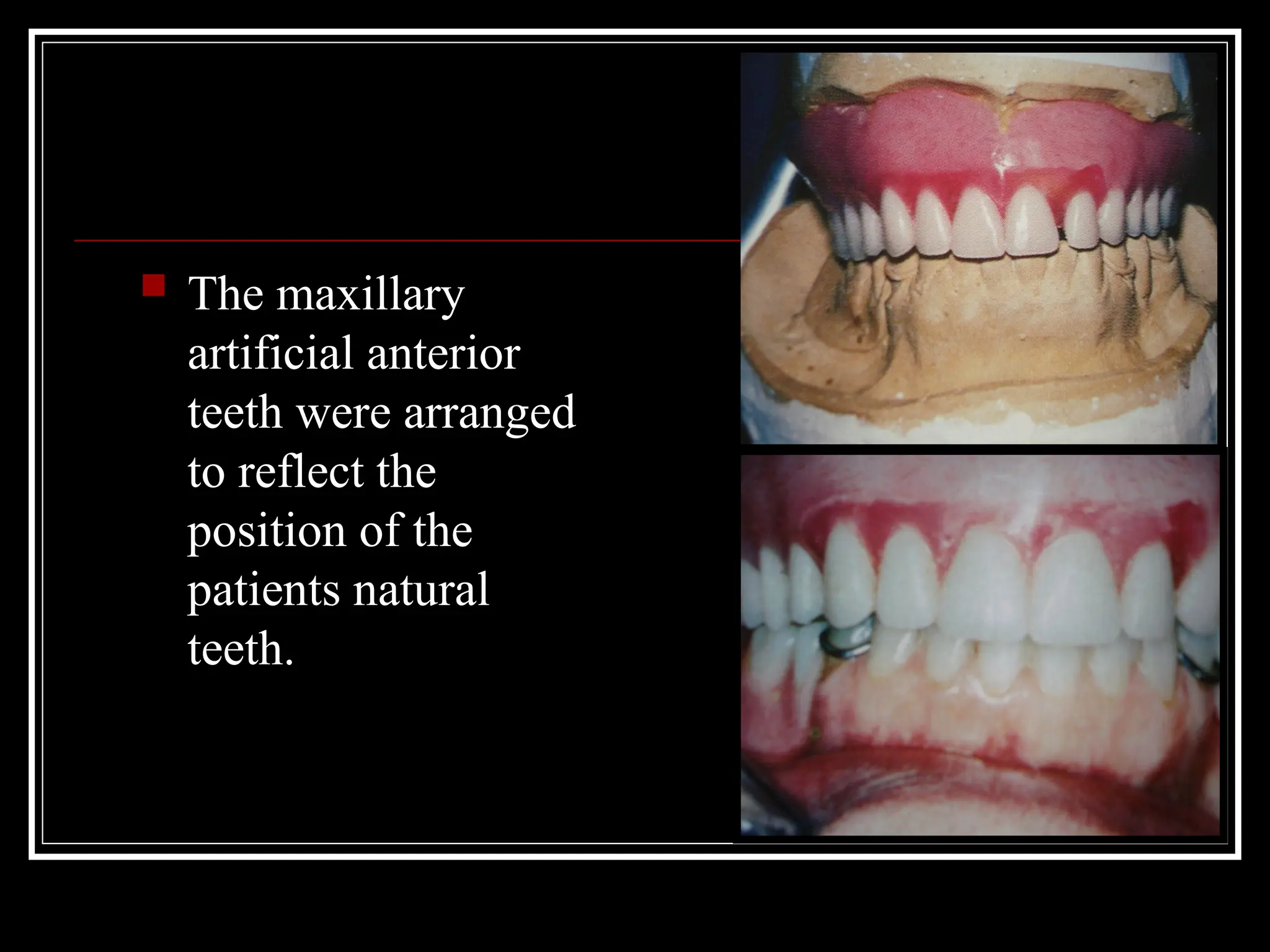 The maxillary
artificial anterior
teeth were arranged
to reflect the
position of the
patients natural
teeth.
 