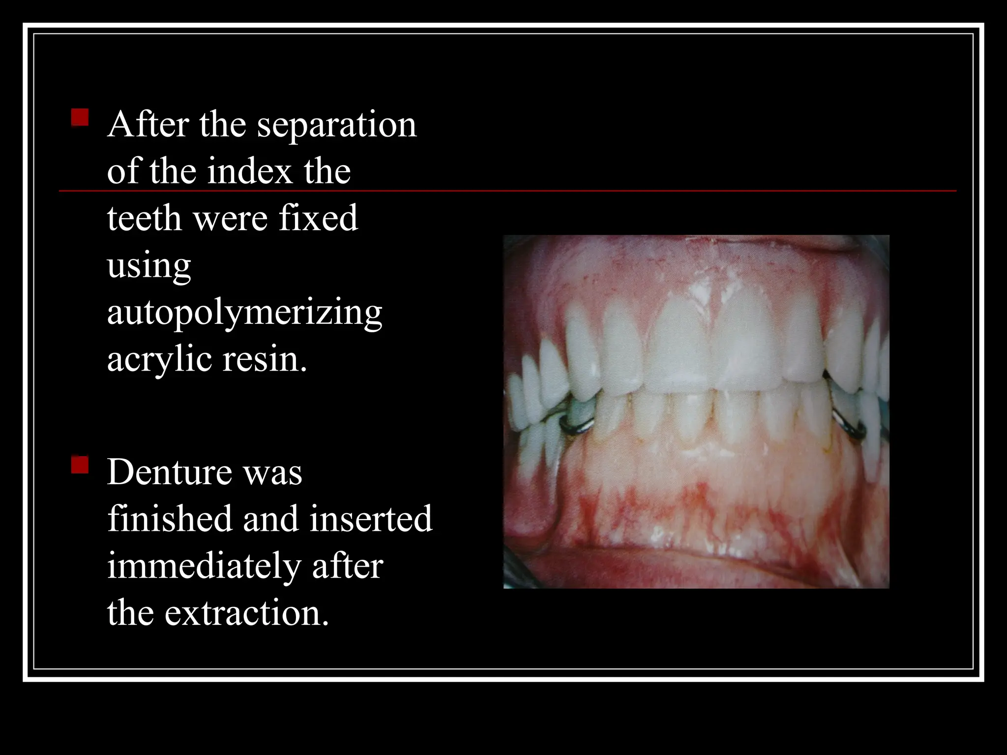  After the separation
of the index the
teeth were fixed
using
autopolymerizing
acrylic resin.
 Denture was
finished and inserted
immediately after
the extraction.
 