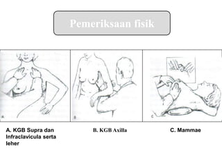 Pemeriksaan fisik
C. Mammae
B. KGB Axilla
A. KGB Supra dan
Infraclavicula serta
leher
 