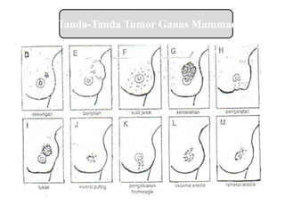 Tanda-Tanda Tumor Ganas Mammae
 