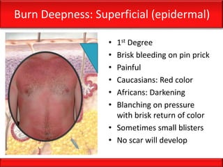 Burn Deepness: Superficial (epidermal)
• 1st Degree
• Brisk bleeding on pin prick
• Painful
• Caucasians: Red color
• Africans: Darkening
• Blanching on pressure
with brisk return of color
• Sometimes small blisters
• No scar will develop
 