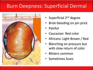 Burn Deepness: Superficial Dermal
• Superficial 2nd degree
• Brisk bleeding on pin prick
• Painful
• Caucasian: Red color
• Africans: Light Brown / Red
• Blanching on pressure but
with slow return of color
• Blisters common
• Sometimes Scars
 