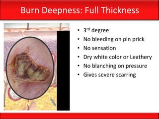 Burn Deepness: Full Thickness
• 3rd degree
• No bleeding on pin prick
• No sensation
• Dry white color or Leathery
• No blanching on pressure
• Gives severe scarring
 
