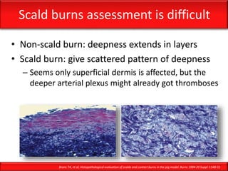 Scald burns assessment is difficult
• Non-scald burn: deepness extends in layers
• Scald burn: give scattered pattern of deepness
– Seems only superficial dermis is affected, but the
deeper arterial plexus might already got thromboses
Brans TA, et al; Histopathological evaluation of scalds and contact burns in the pig model. Burns 1994:20 Suppl 1:S48-51
 