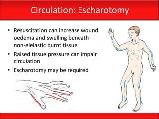 Circulation: Escharotomy
• Resuscitation can increase wound
oedema and swelling beneath
non-elelastic burnt tissue
• Raised tissue pressure can impair
circulation
• Escharotomy may be required
 