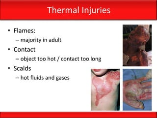 Thermal Injuries
• Flames:
– majority in adult
• Contact
– object too hot / contact too long
• Scalds
– hot fluids and gases
 