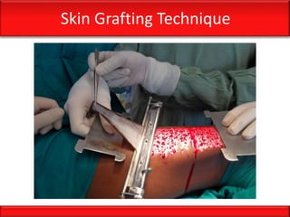 Skin Grafting Technique
 