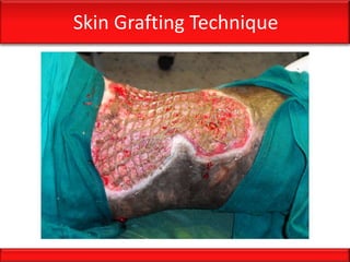 Skin Grafting Technique
 