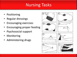 Nursing Tasks
• Positioning
• Regular dressings
• Encouraging exercises
• Encouraging proper feeding
• Psychosocial support
• Monitoring
• Administering drugs
 