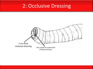 2: Occlusive Dressing
 