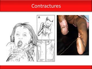 Contractures
 