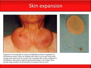 Skin expansion
 