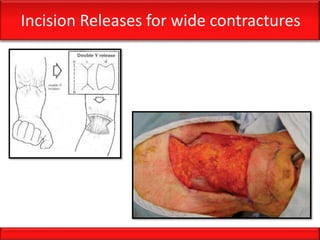 Incision Releases for wide contractures
 