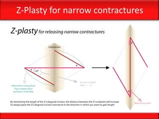 Z-Plasty for narrow contractures
 