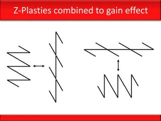 Z-Plasties combined to gain effect
 
