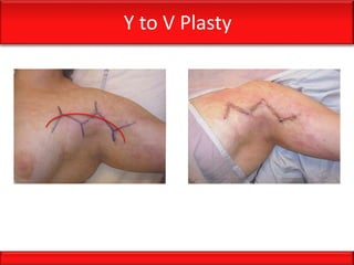 Y to V Plasty
 