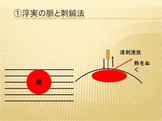 実 速刺速抜 熱をぬく 