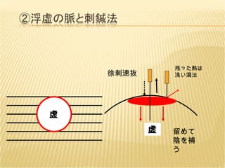 虚 徐刺速抜 虚 留めて陰を補う 残った熱は浅い瀉法 