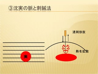 実 速刺徐抜 熱を拡散 