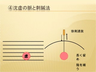 虚 徐刺速抜 長く留め 陰を補う 