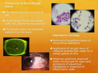 Fluorescein & Rose Bengal
Stains
1% placed into the conjunctival
sac.
 Rose bengal Stains devitalized
cells. Also stains mucous strands
Fluorescein stains the epithelial
defects from the dead
Impression Cytology
Removal of superficial layers of
conjunctival epithelium
Application of circular discs of
cellulose acetate filter paper for a
certain period of time.
Obtained specimen observed
under microscope for signs and
symptoms of squamous
metaplasia or presence of
inflammatory cells.
 