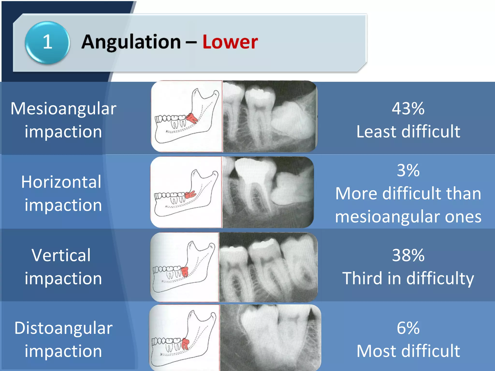 Mesioangular impaction 43% Least difficult Horizontal  impaction 3% More difficult than mesioangular ones Vertical  impaction 38% Third in difficulty Distoangular impaction 6% Most difficult 