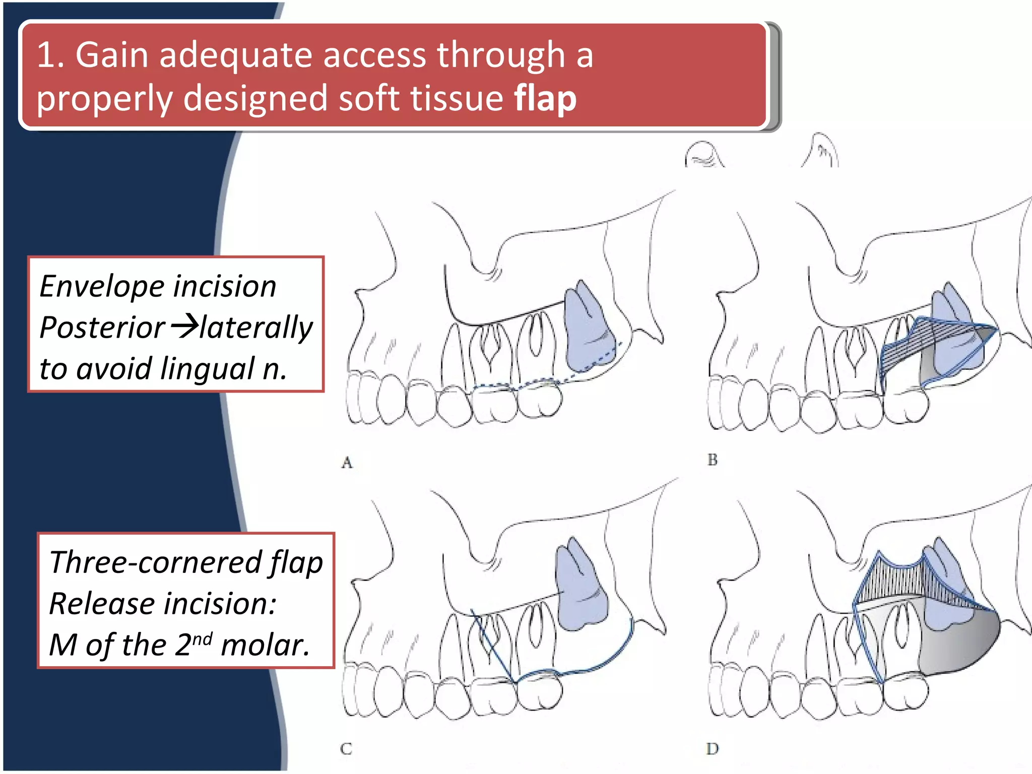 Envelope incision Posterior  laterally to avoid lingual n. Three-cornered flap Release incision: M of the 2 nd  molar. 1. Gain adequate access through a properly designed soft tissue  flap 