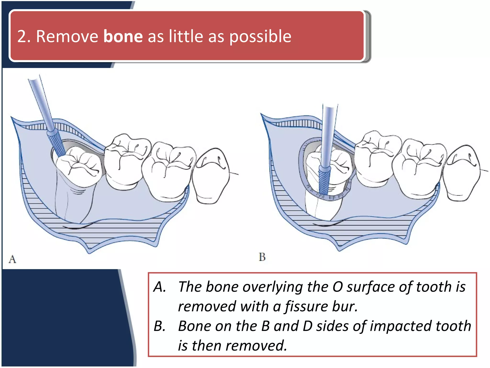 The bone overlying the O surface of tooth is removed with a fissure bur. Bone on the B and D sides of impacted tooth is then removed. 2. Remove  bone  as little as possible 