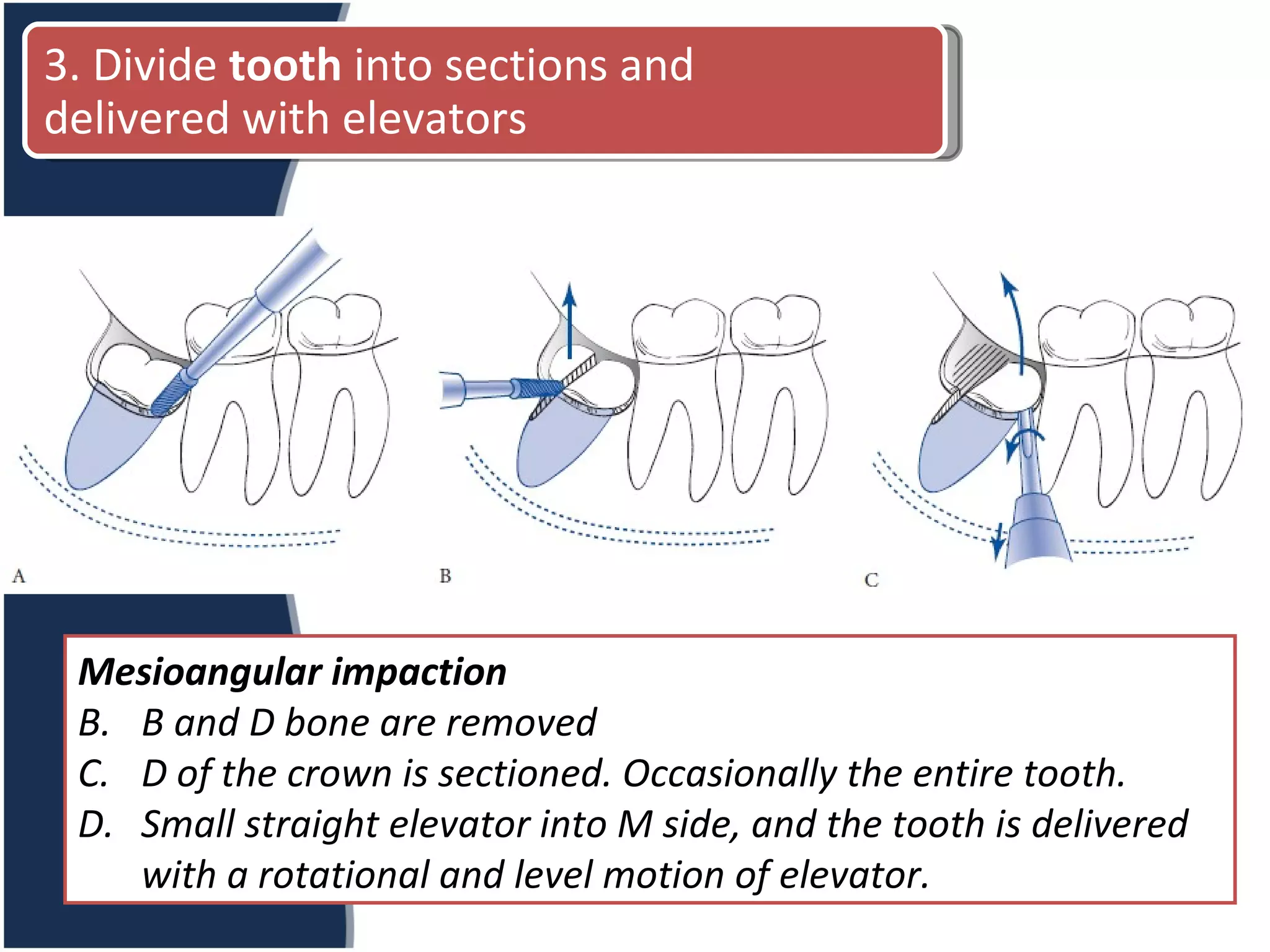 Mesioangular impaction B and D bone are removed D of the crown is sectioned. Occasionally the entire tooth. Small straight elevator into M side, and the tooth is delivered with a rotational and level motion of elevator. 3. Divide  tooth  into sections and delivered with elevators 