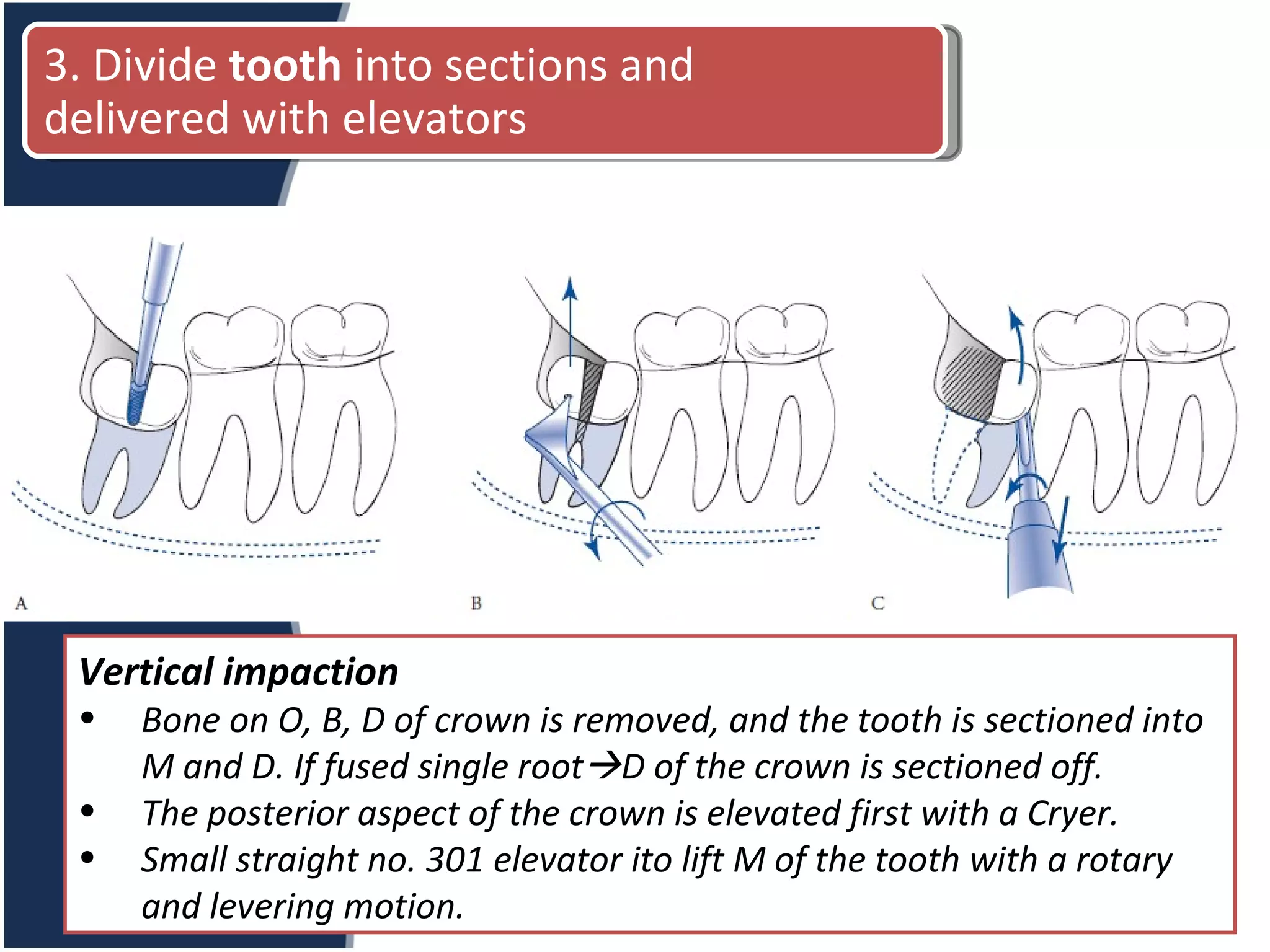Vertical impaction Bone on O, B, D of crown is removed, and the tooth is sectioned into M and D. If fused single root  D of the crown is sectioned off. The posterior aspect of the crown is elevated first with a Cryer. Small straight no. 301 elevator ito lift M of the tooth with a rotary and levering motion. 3. Divide  tooth  into sections and delivered with elevators 