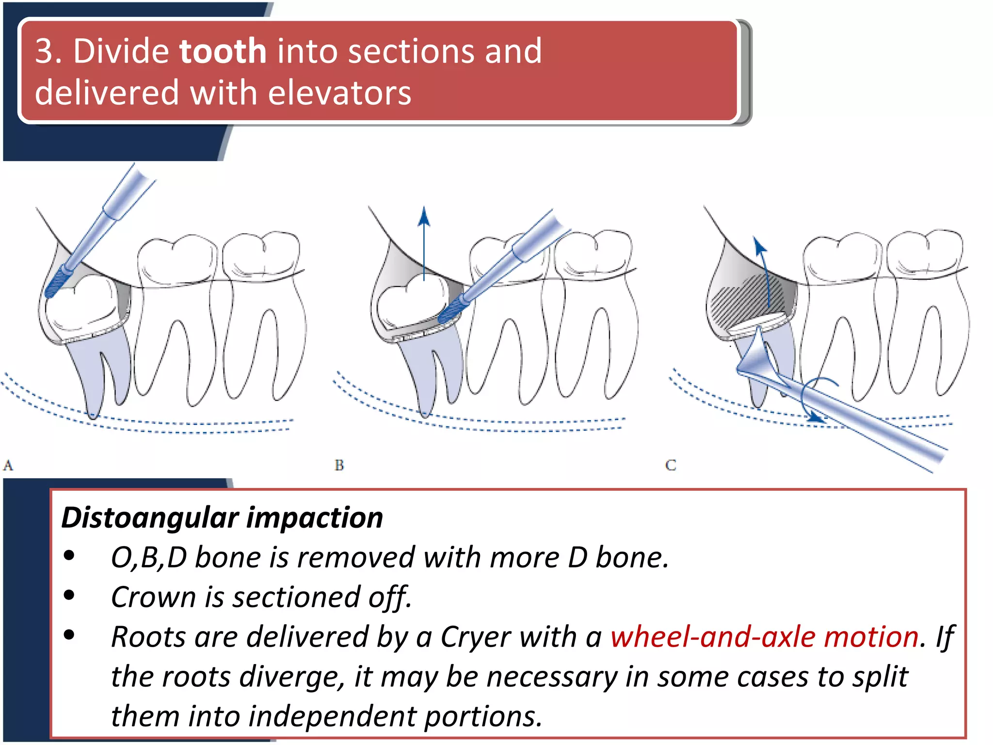 Distoangular impaction O,B,D bone is removed with more D bone. Crown is sectioned off. Roots are delivered by a Cryer with a  wheel-and-axle motion . If the roots diverge, it may be necessary in some cases to split them into independent portions. 3. Divide  tooth  into sections and delivered with elevators 