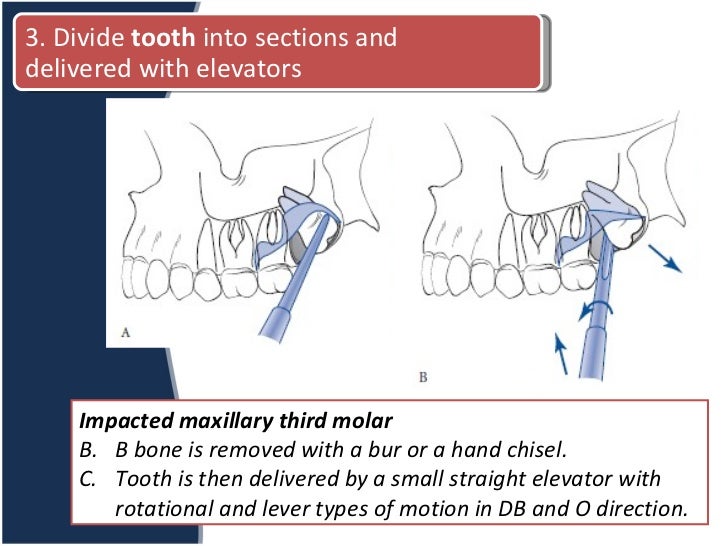 Complicated Extraction and Odontectomy