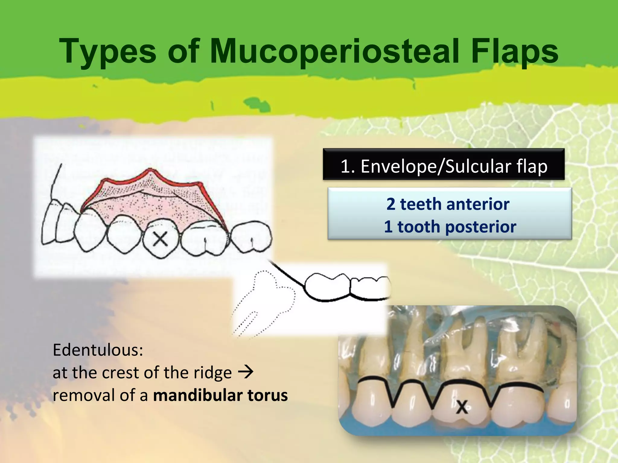 Types of Mucoperiosteal Flaps Edentulous: at the crest of the ridge   removal of a  mandibular torus 2 teeth anterior  1 tooth posterior 1. Envelope/Sulcular flap 